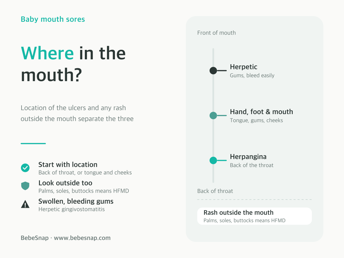 Baby mouth sores comparison - herpangina at the back of the throat, hand foot and mouth on tongue and cheeks with rash outside, herpetic on the gums
