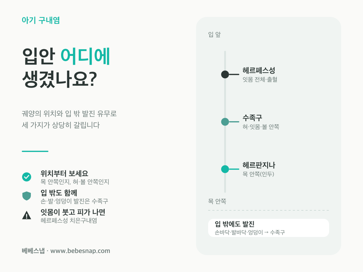 아기 구내염 구별법 - 헤르판지나는 목 안쪽, 수족구는 혀·볼 안쪽과 손발 발진, 헤르페스성은 잇몸에 생기는 위치 비교 도식